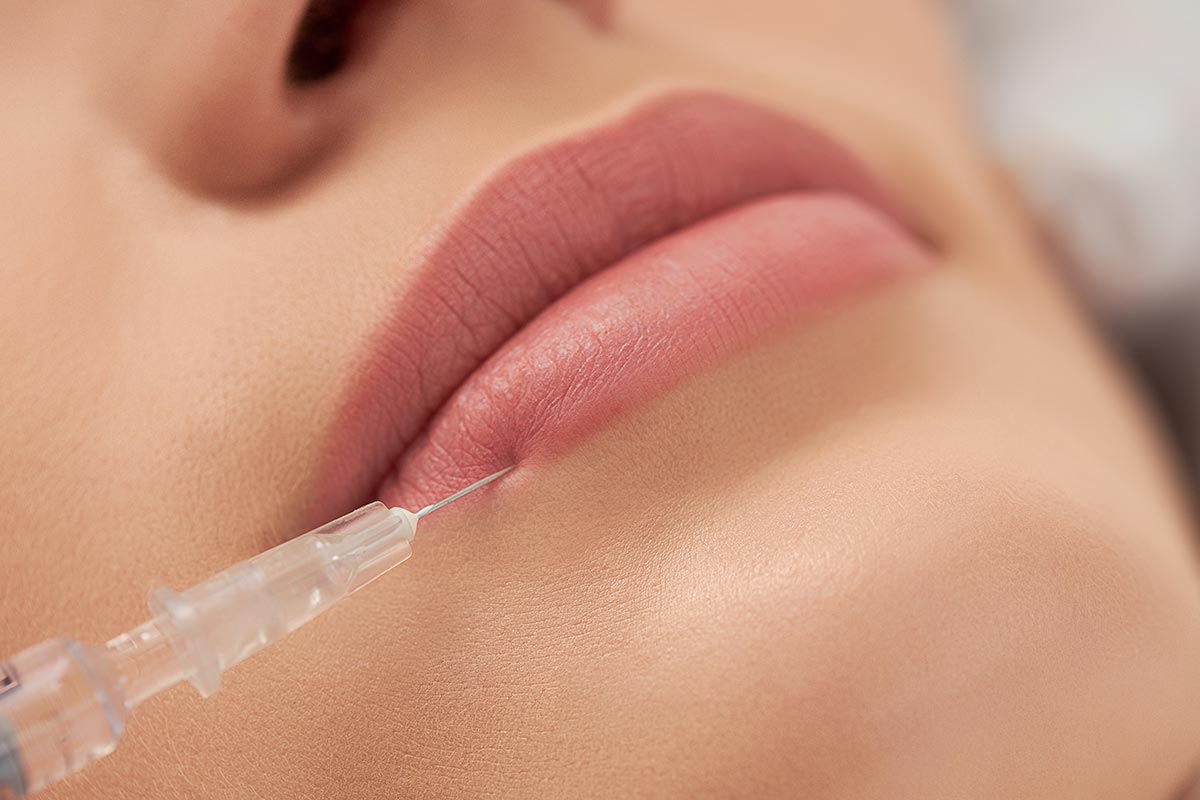 Filler labbra: naturalezza e armonia senza eccessi